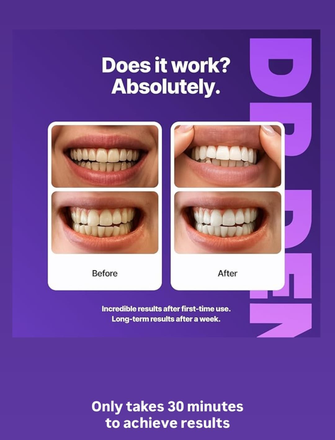 Dr Dent Before and After Teeth Whitening Results